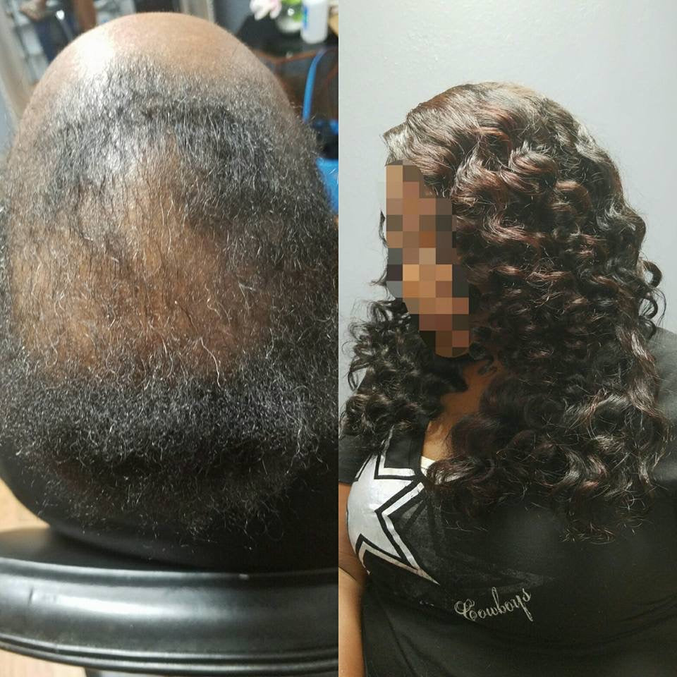 Sewin for thinning and balding
